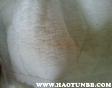 最新肺炎淤青的成因、表現(xiàn)與防治策略解析